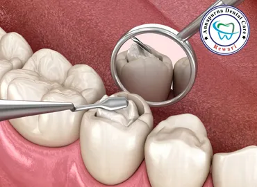 Fillings and Sealants