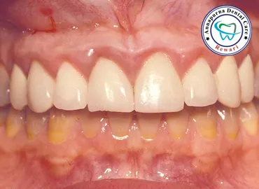 Periodontal Problems