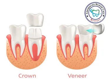 Veneers and Crowns